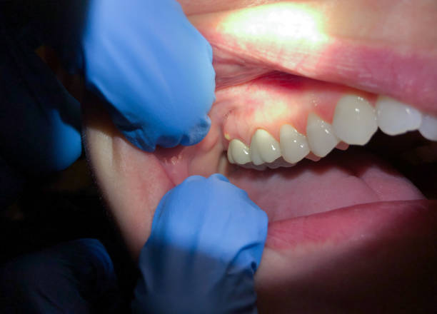 Best Emergency Root Canal Treatment in Mooreland, OK