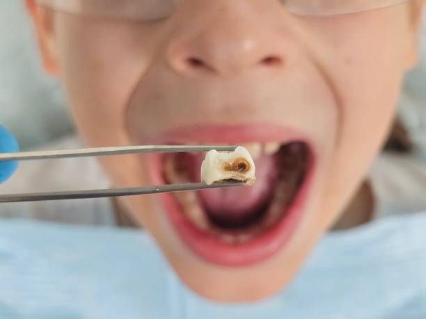Best Emergency Dental Extractions in Mooreland, OK